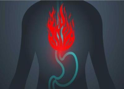 رفلاکس معده یا ترش کردن